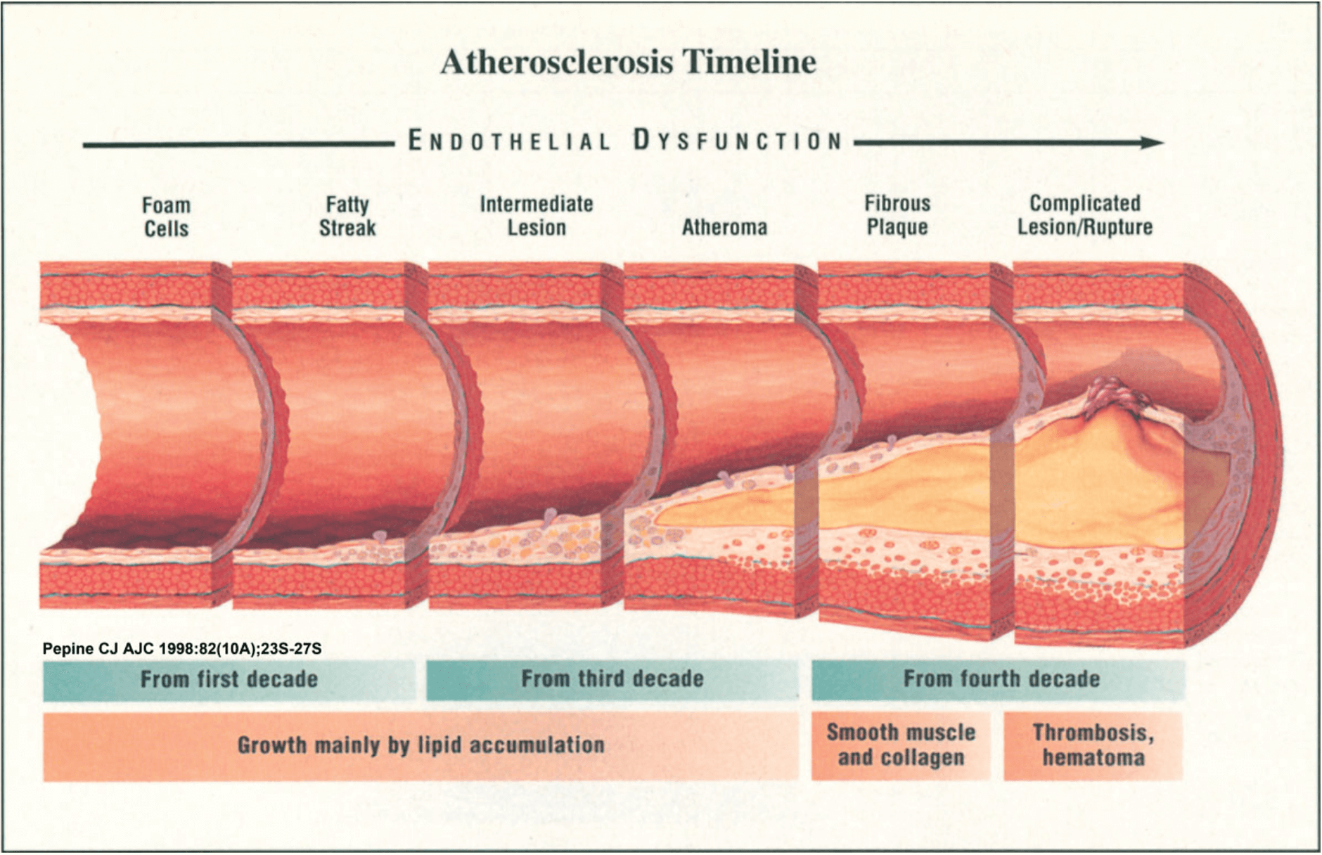 Артерий атеросклероз латынь. Развитие атеросклероза. Развития атересклероз. Стадии развития атеросклероза.